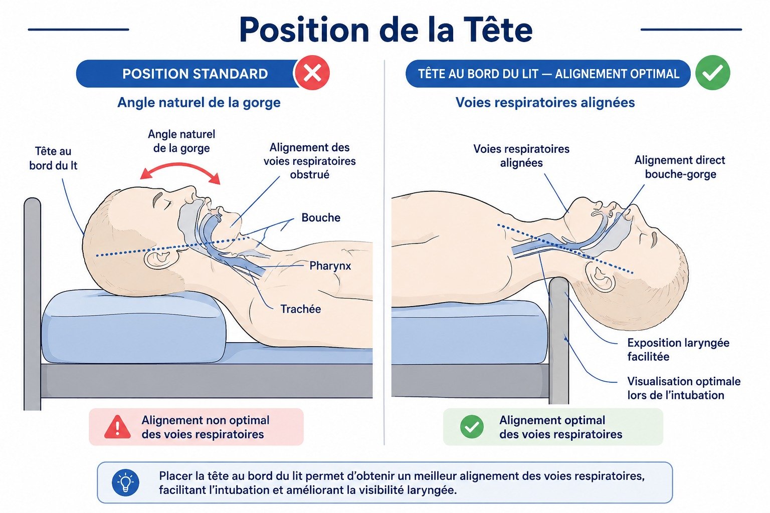 Position de la tête: alignement optimal des voies respiratoires lors de l’intubation, avec exposition laryngée facilitée et visualisation optimale.